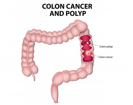 Colon Cancer & Polyp